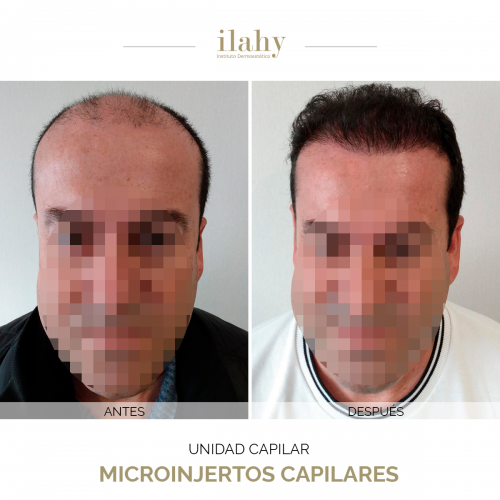 Microinjertos capilares